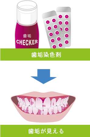 歯垢染色剤で歯垢が見える
