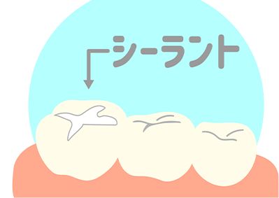 シーラント