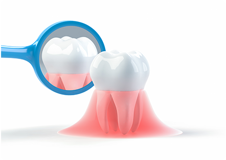 歯のクリーニングは重要なの？