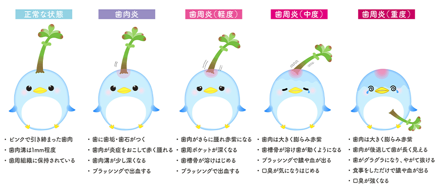 歯周病の進行度チェック
