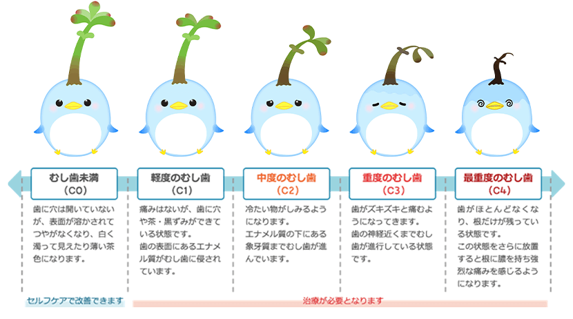 むし歯のステージと状態
