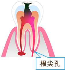 むし歯のしくみ