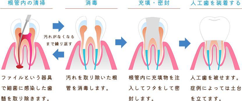 根管治療の流れ