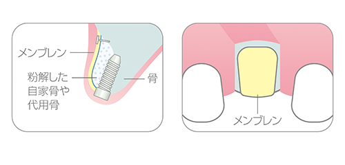 ＧＢＲ　Guided Bone Regeneration（骨再生誘導法）