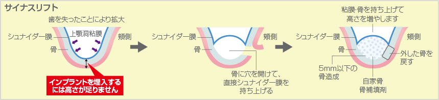 サイナスリフト法