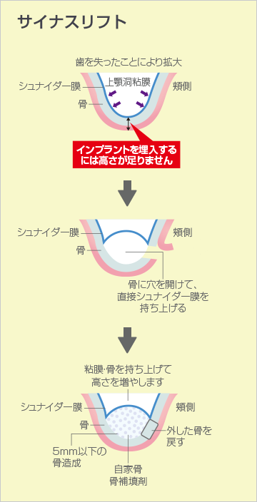 サイナスリフト法
