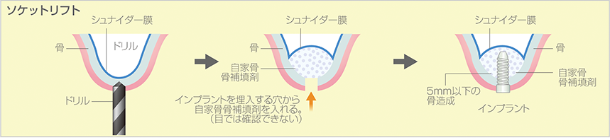 ソケットリフト法