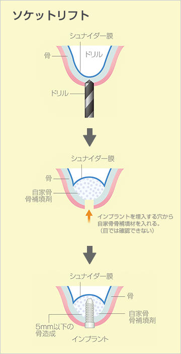 ソケットリフト法